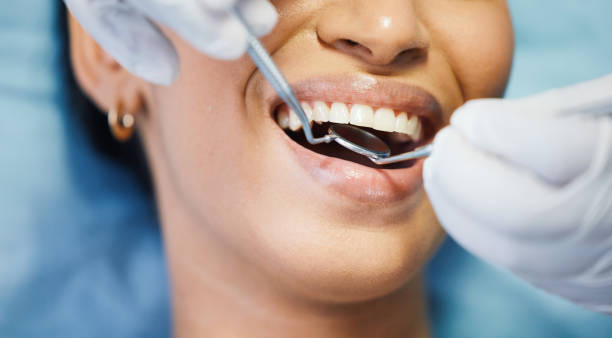 Best Knocked-Out Tooth (Avulsed Tooth) Treatment in Cheraw, SC
