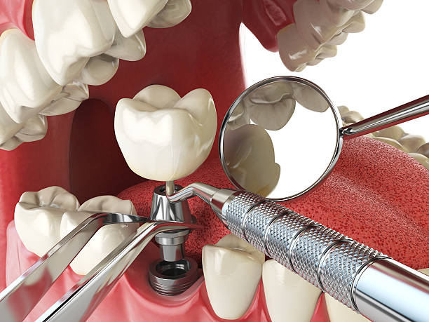 Best Emergency Dental Care for Sports Injuries in Cheraw, SC
